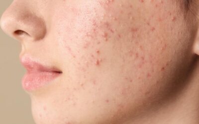 ¿Cómo debes alimentarte si sufres de acné?