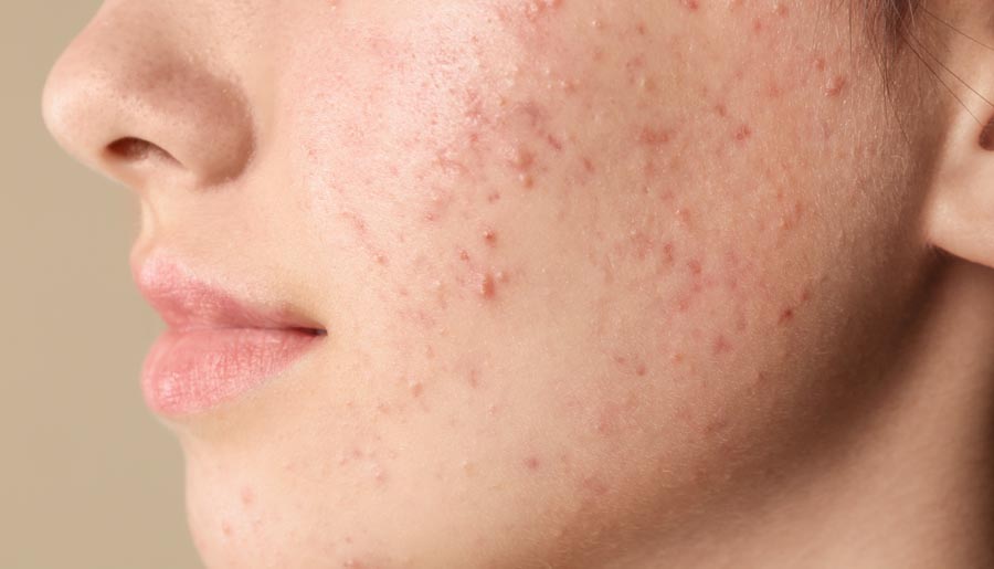 ¿Cómo debes alimentarte si sufres de acné?